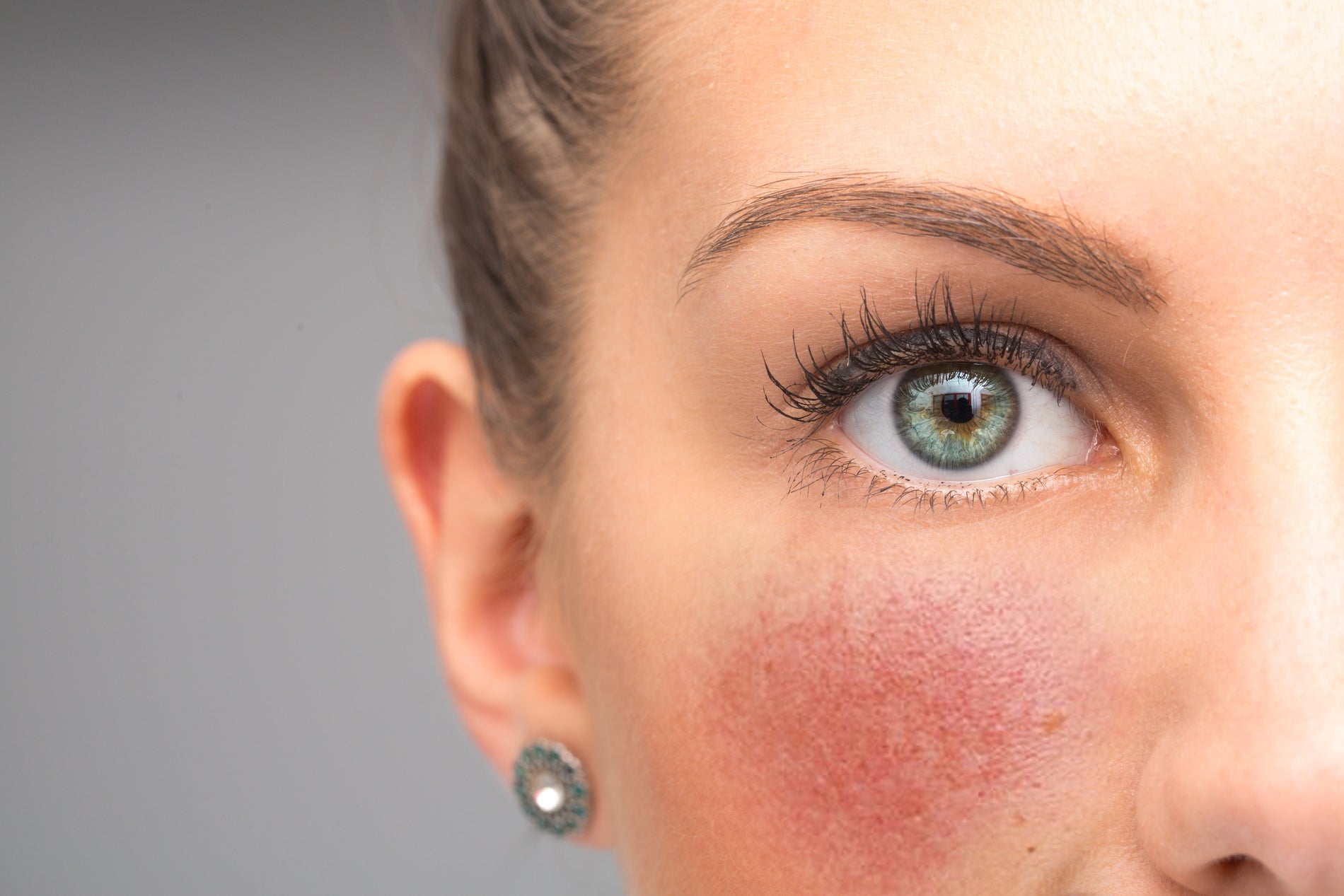 A Comprehensive Guide to Rosacea