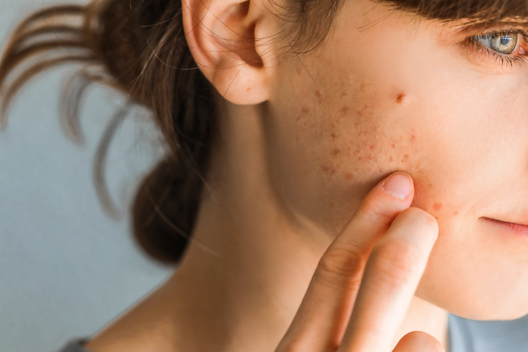 Hormonal Acne: What It Is and Why It Happens